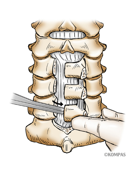脊椎1¥1.頚椎椎弓形成術（片開き式脊柱管拡大術）¥２．片開き式椎弓形成術図2.jpg