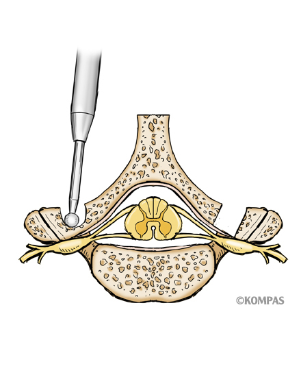 脊椎1¥1.頚椎椎弓形成術（片開き式脊柱管拡大術）¥１．片開き式椎弓形成術図1.jpg
