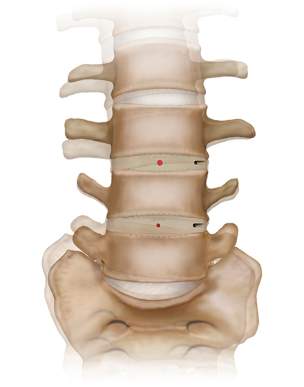 脊椎2¥6.低侵襲脊椎手術（OLIF）¥３．まっすぐに戻った背骨.jpg