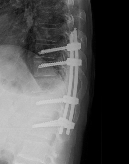 脊椎2¥7.低侵襲脊椎手術（MISt）¥５．術後側面レントゲン.jpg