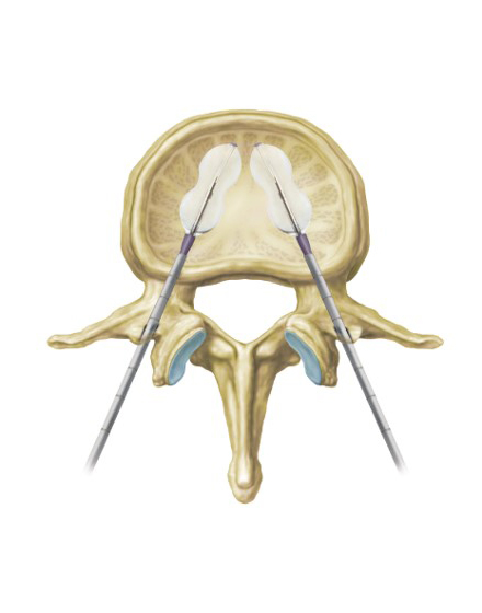 脊椎2¥4.低侵襲脊椎手術（BKP）¥３．バルーン拡張１.jpg