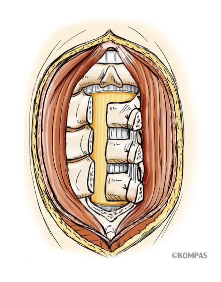 脊椎1¥1.頚椎椎弓形成術（片開き式脊柱管拡大術）¥３．片開き式椎弓形成術図3.jpg
