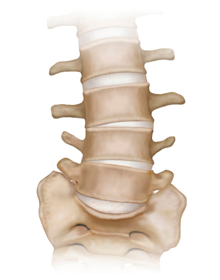 脊椎2¥6.低侵襲脊椎手術（OLIF）¥１．術前の曲がった背骨.jpg