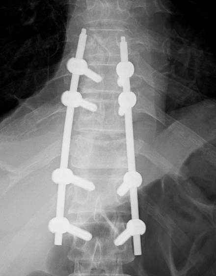 脊椎2¥7.低侵襲脊椎手術（MISt）¥４．術後正面レントゲン.jpg