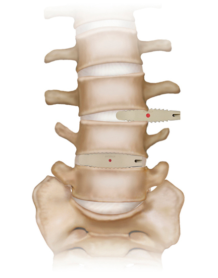 脊椎2¥6.低侵襲脊椎手術（OLIF）¥２．手術で背骨を矯正.jpg