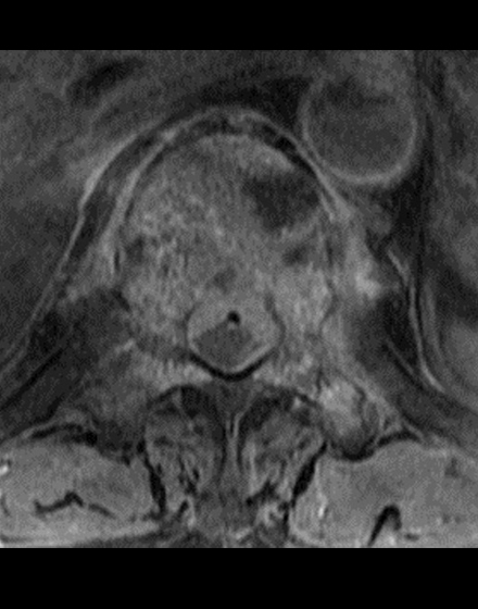 脊椎2¥7.低侵襲脊椎手術（MISt）¥２．術前MRI2.jpg