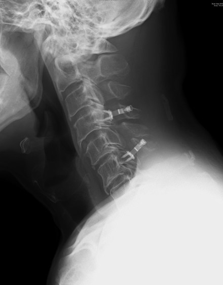 脊椎1¥1.頚椎椎弓形成術（片開き式脊柱管拡大術）¥５．術後レントゲン.jpg