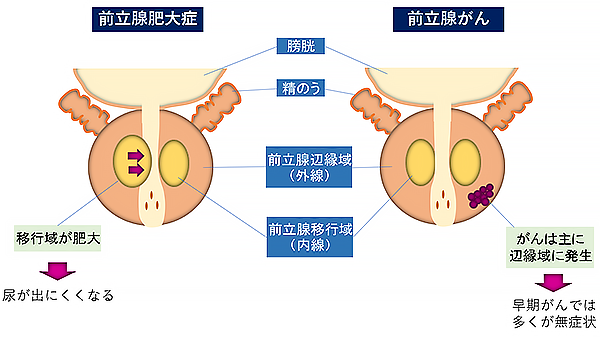 前立腺がん図2