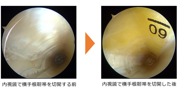 内視鏡で横手根靭帯を切開する前 内視鏡で横手根靭帯を切開した後