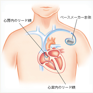 ペースメーカー植え込み後の模式図
