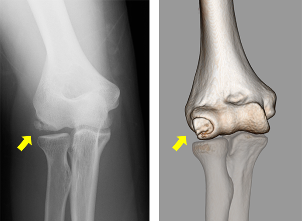 上腕骨小頭離断性骨軟骨炎のX線、CT
