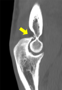 肘関節後方の骨棘と遊離体（後方インピンジメント）