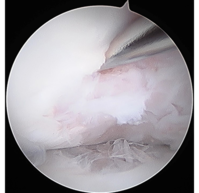 内視鏡下のドリリング