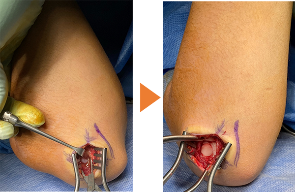 離断性骨軟骨炎に対して、膝から採取した骨軟骨柱を直視下に移植