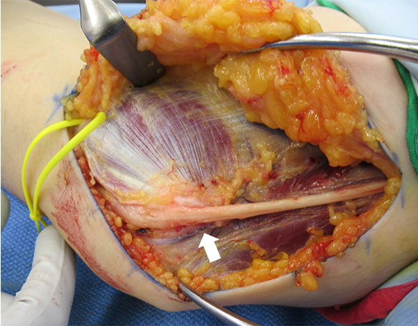 肘部管を開放して尺骨神経(白矢印)の剥離を行っている