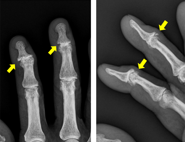 へバーデン結節