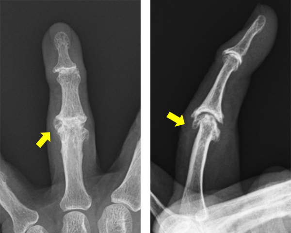 ブシャール結節