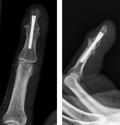 へバーデン結節に対する関節固定術