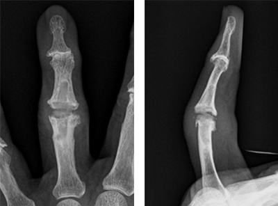 ブシャール結節に対する人工関節置換術