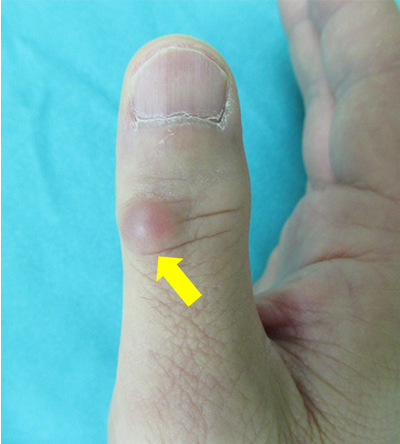 親指のへバーデン結節に合併した粘液嚢腫