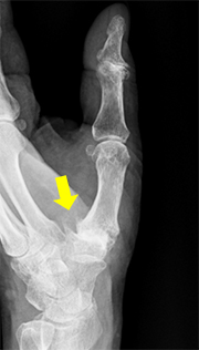 母指CM関節の変形、骨棘形成、亜脱臼を認める