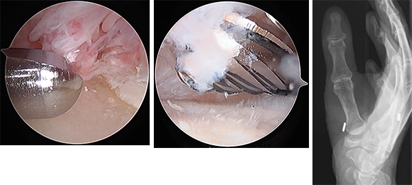 鏡視下関節形成術