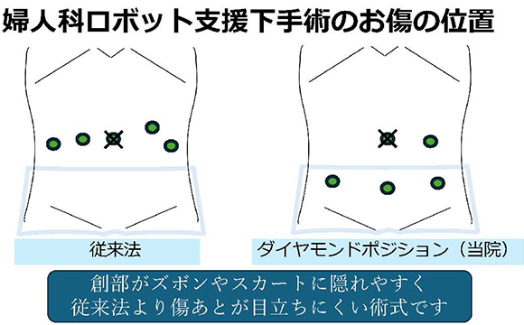 画像：婦人科ロボット支援下手術のお腹の傷の位置