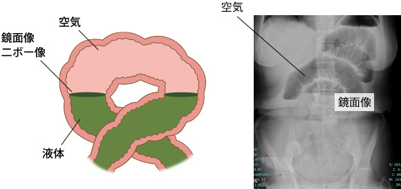 腸閉塞の見通し